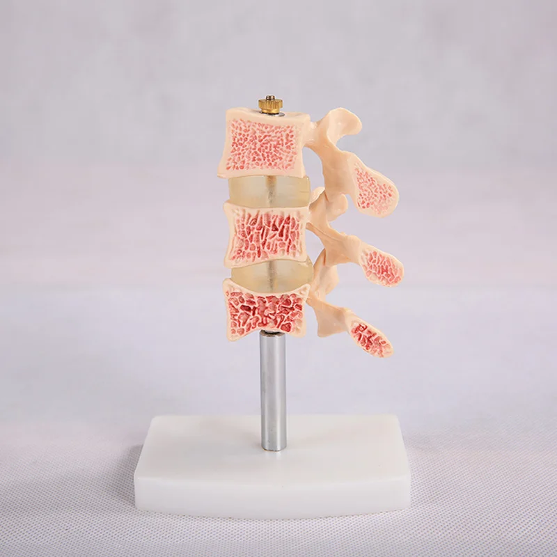 Medical school training and teaching anatomical skeleton spinal typical lesion model
Medical school training and teaching anatomical skeleton spinal typical lesion model