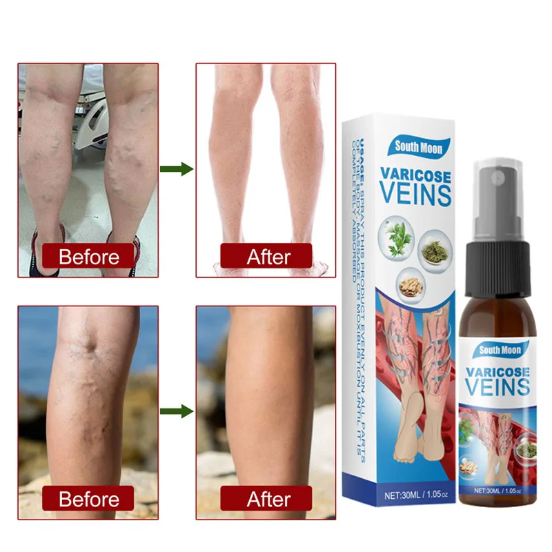 Varicose Veins Relief Spray Vasculitis Phlebitis Spider Legs Smoothing Ointment Treatment Blood Swelling Medical Healthy Care
Varicose Veins Relief Spray Vasculitis Phlebitis Spider Legs Smoothing Ointment Treatment Blood Swelling Medical Healthy Care