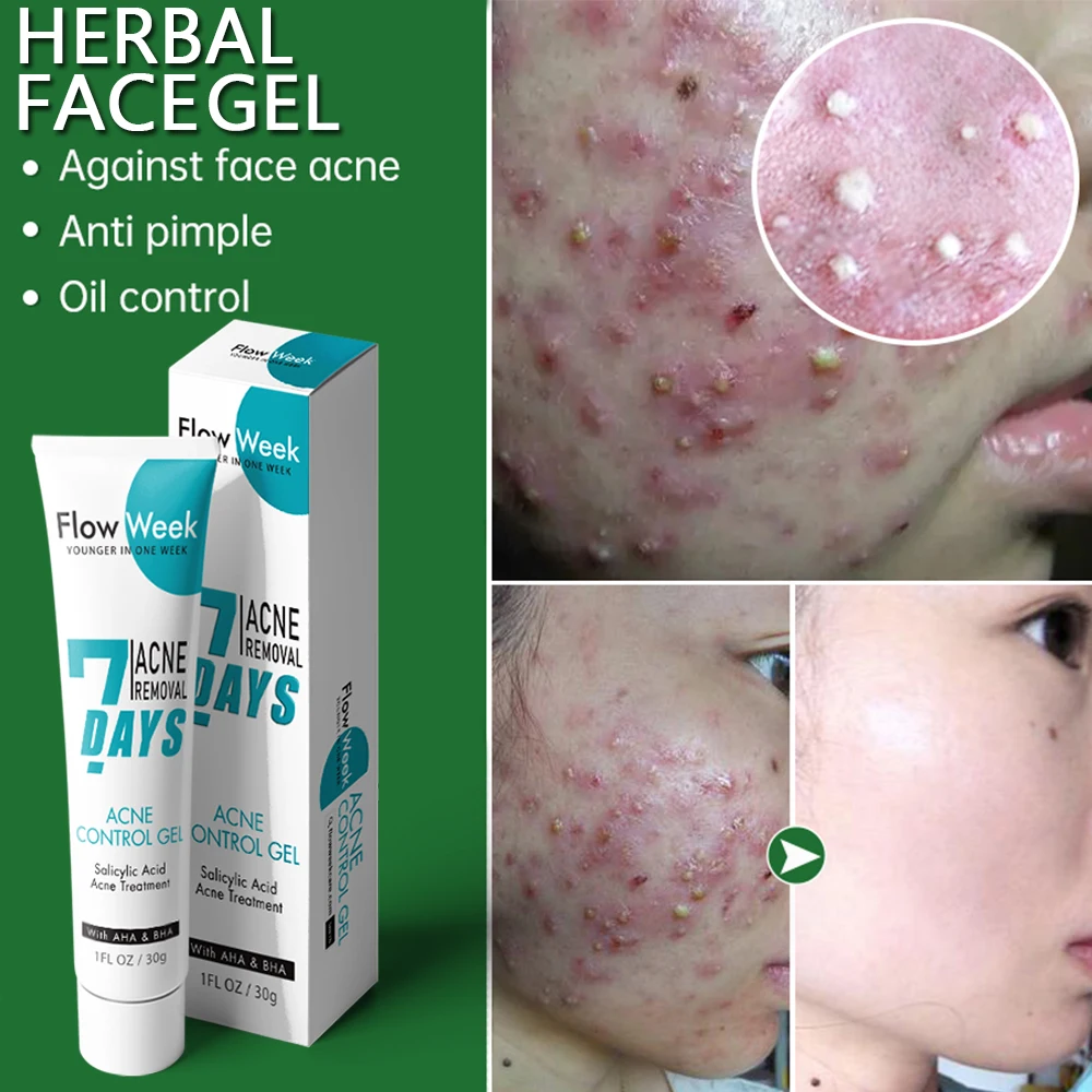FlowWeek Effective Beauty Health Acne Remove Gel Treatment Spot Skin Tags Care Control Oil Shrink Pores Moisturize Brightening
FlowWeek Effective Beauty Health Acne Remove Gel Treatment Spot Skin Tags Care Control Oil Shrink Pores Moisturize Brightening