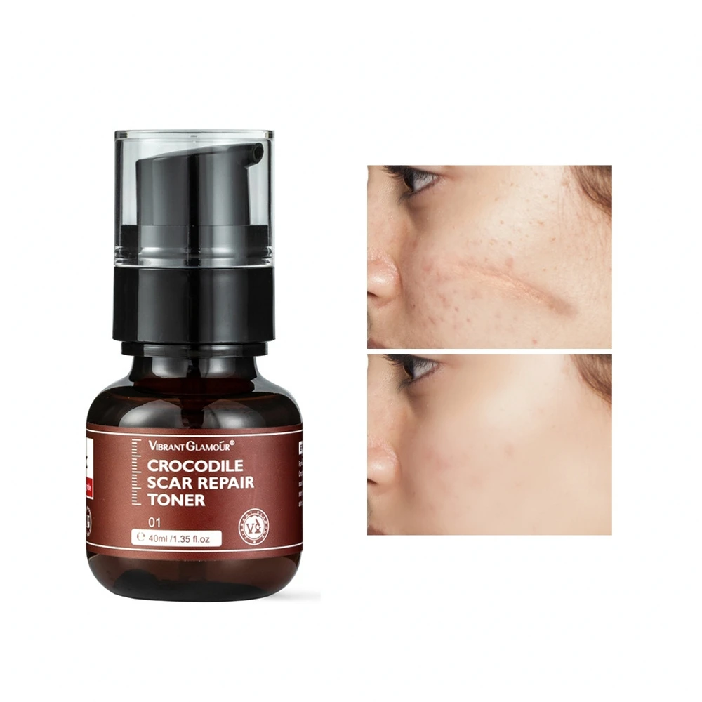 Crocodile Scar Repair Toner Reduce Scar Area Fade Scar Color Prevent Scar Hyperplasia Sensitive Skin Deep Care
Crocodile Scar Repair Toner Reduce Scar Area Fade Scar Color Prevent Scar Hyperplasia Sensitive Skin Deep Care