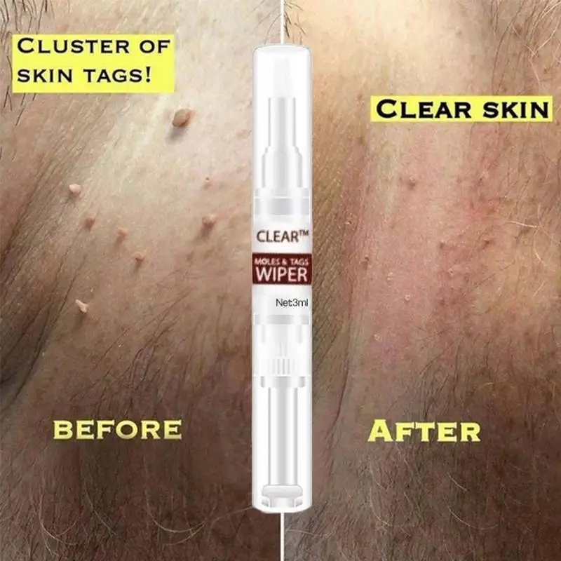 Clear Moles & Tag Wiper Wipe Off Tags & Moles Remover Removal Mole Painless Freckle Liquid Spot Organic 3ml
Clear Moles & Tag Wiper Wipe Off Tags & Moles Remover Removal Mole Painless Freckle Liquid Spot Organic 3ml