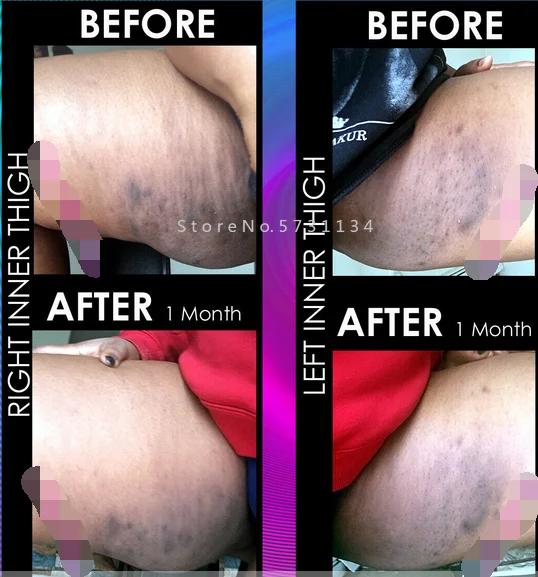 Before and After Natural Skin Whitening Bleach Lightening Acne Scar Spots Freckle Cream
Before and After Natural Skin Whitening Bleach Lightening Acne Scar Spots Freckle Cream