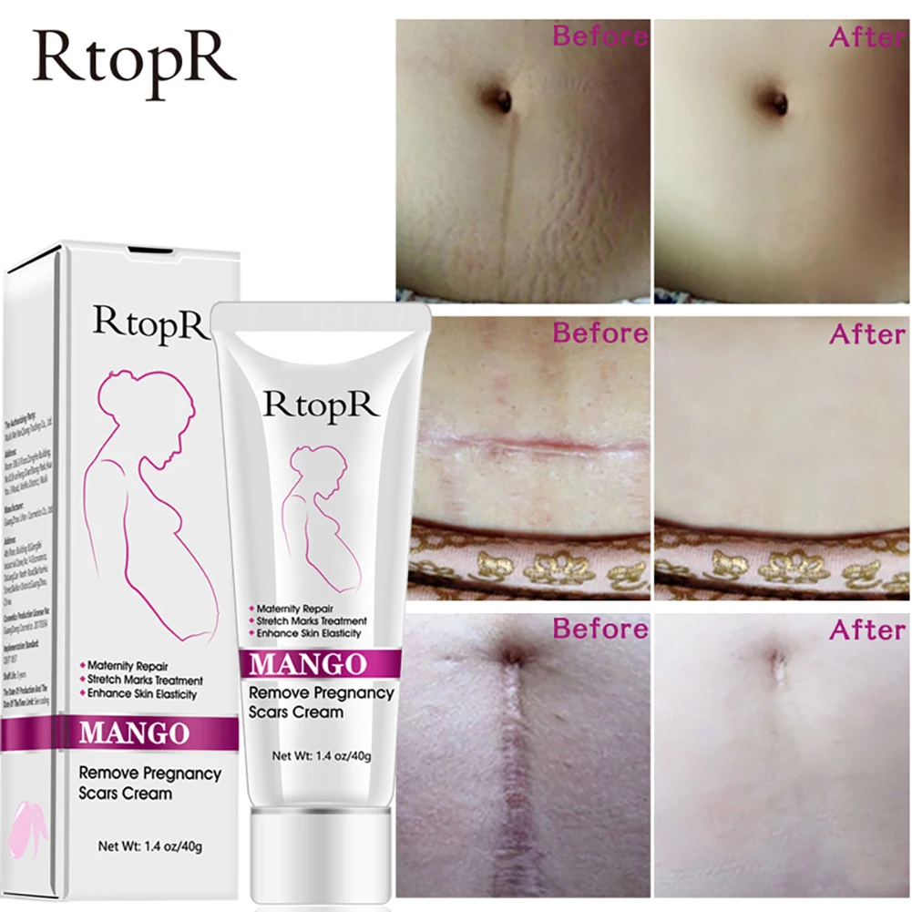 Hotsell Removes Stretch Mark Cream To Remove Postpartum Obesity Pregnant Women Repair Anti-Aging Anti-Winkles Firming Body Cream
Hotsell Removes Stretch Mark Cream To Remove Postpartum Obesity Pregnant Women Repair Anti-Aging Anti-Winkles Firming Body Cream