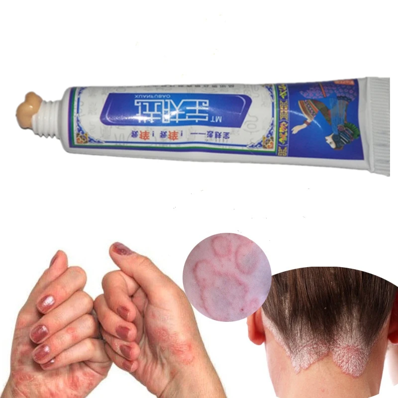 Body Eczema Cream Psoriasis Skin Allergy Dermatitis Itching Psoriasis Eczema Skin Repair Chinese Herbal Skin Care Psoriasis
Body Eczema Cream Psoriasis Skin Allergy Dermatitis Itching Psoriasis Eczema Skin Repair Chinese Herbal Skin Care Psoriasis