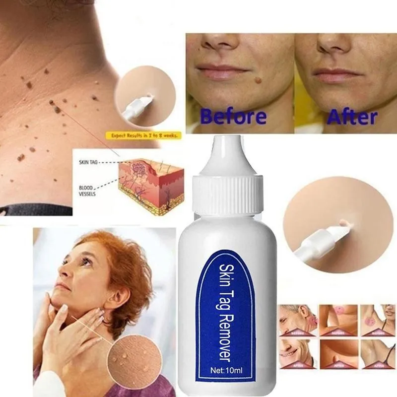 Genital Wart Treatment Liquid Wart Removal Pen Fast Removal Mole & Genital Wart Foot Corn Skin Tag Remover Skin Care
Genital Wart Treatment Liquid Wart Removal Pen Fast Removal Mole & Genital Wart Foot Corn Skin Tag Remover Skin Care