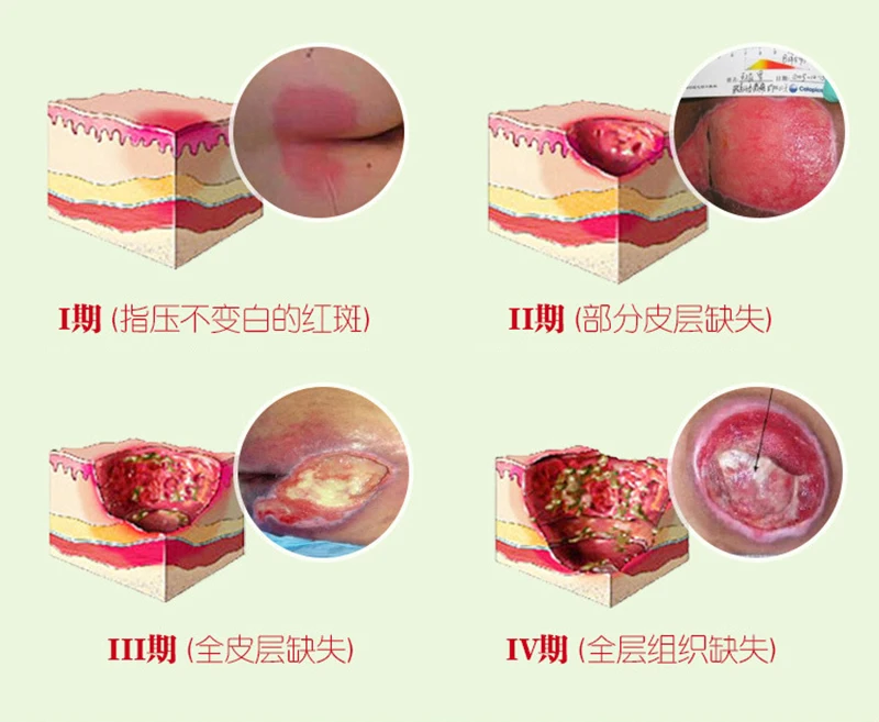ZB Chinese Herbal medicine removal rot myogeniccream bedsores paste treat pressure sores ulcer festering wound healing 
ZB Chinese Herbal medicine removal rot myogeniccream bedsores paste treat pressure sores ulcer festering wound healing