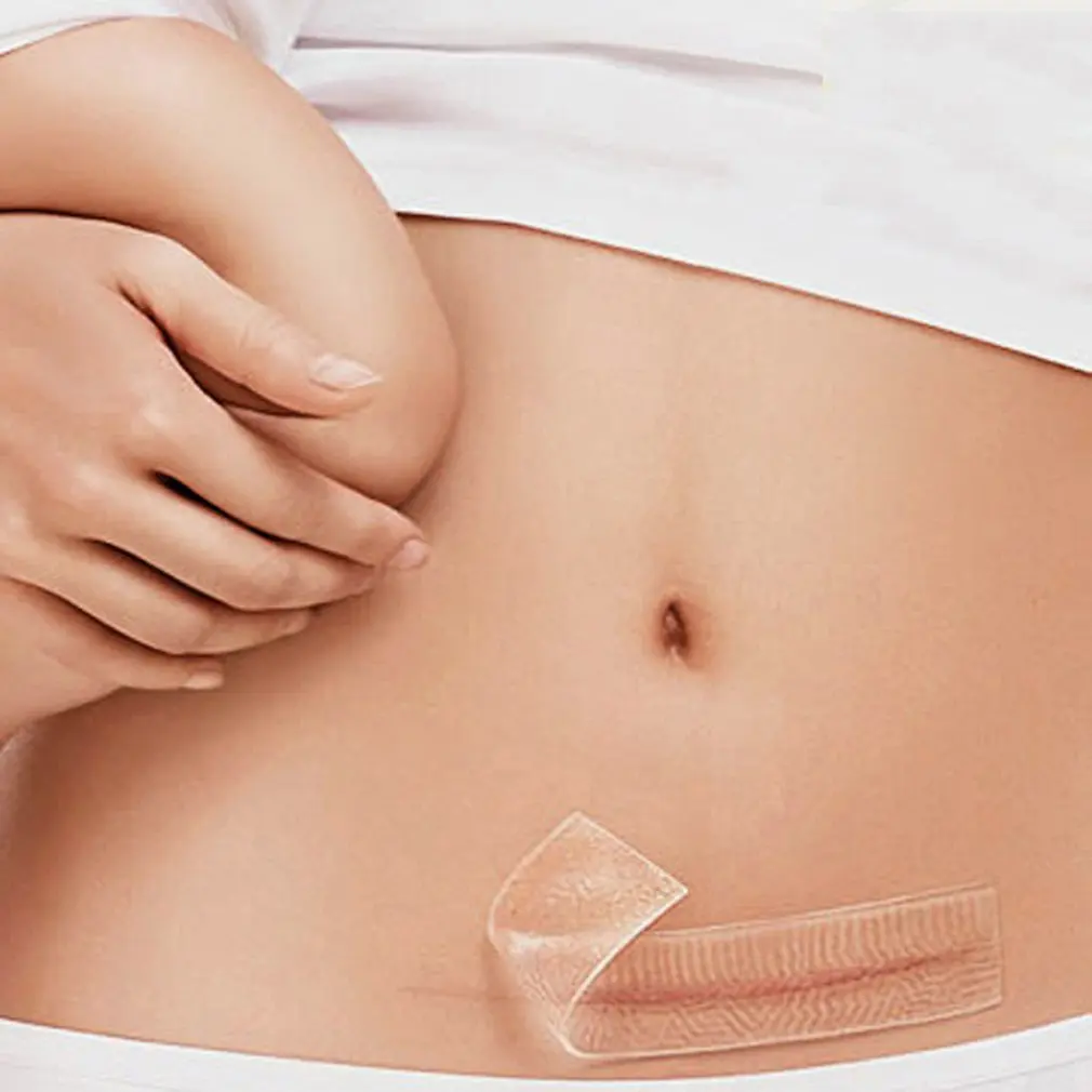 Silicone Scar Gel Away Strips Paste Medical Trauma Burn Scar Sheet Skin Repair Scar Therapy Patch Removel Scar
Silicone Scar Gel Away Strips Paste Medical Trauma Burn Scar Sheet Skin Repair Scar Therapy Patch Removel Scar