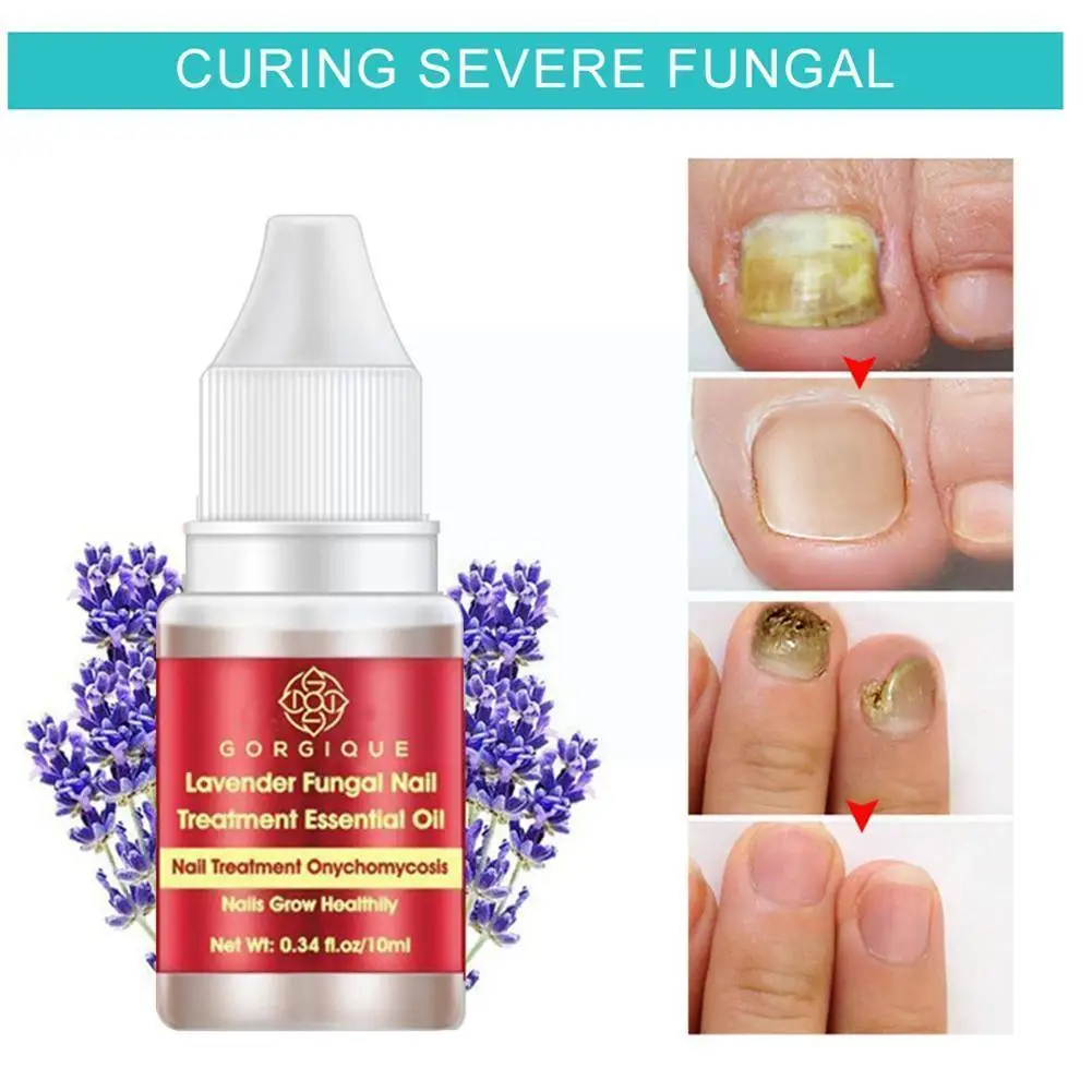 Lavender Nourishing Nail Essential Oil Fungus Nail Repair Onychomycosis Care Removal Anti And Foot G4Q8
Lavender Nourishing Nail Essential Oil Fungus Nail Repair Onychomycosis Care Removal Anti And Foot G4Q8