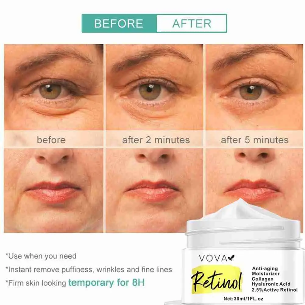 30G Retinol Effective Remove Melasma Acne Spot Pigment Freckle Dark Spots Moisturizing Melanin Whitening Pigmentation Cream G7J4 
30G Retinol Effective Remove Melasma Acne Spot Pigment Freckle Dark Spots Moisturizing Melanin Whitening Pigmentation Cream G7J4