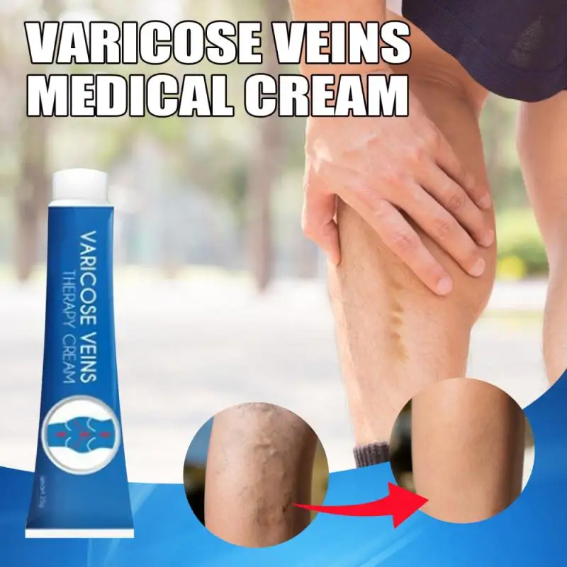 Natural Varicose Veins Cream Varicose Veins Ointment Natural Treatment For Relief Phlebitis Angiitis Leg Smearing Cream Remedies
Natural Varicose Veins Cream Varicose Veins Ointment Natural Treatment For Relief Phlebitis Angiitis Leg Smearing Cream Remedies