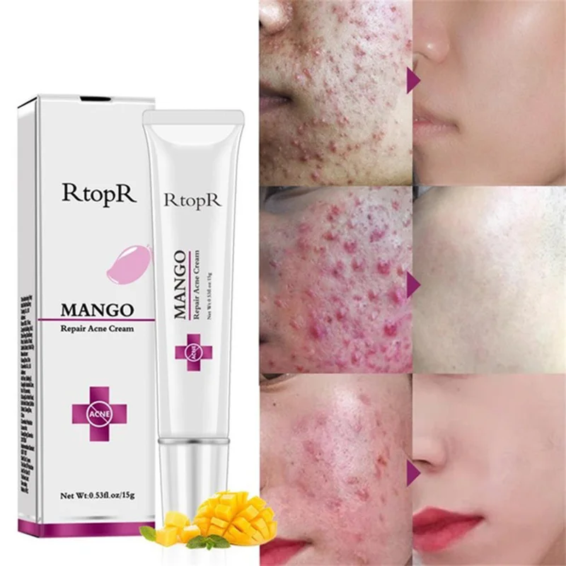 Anti Stains Acne Treatment Scar Blackhead CreamShrink Pores Whitening Moisturizing Face Skin Care Mango Repair Acne Cream TSLM1
Anti Stains Acne Treatment Scar Blackhead CreamShrink Pores Whitening Moisturizing Face Skin Care Mango Repair Acne Cream TSLM1