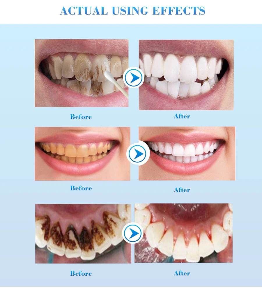 Teeth Whitening Pen Tooth Gel Whitener Bleaching Pen Remove Stains Plaque Oral Hygiene Smile Dental Teeth Whitening Serum
Teeth Whitening Pen Tooth Gel Whitener Bleaching Pen Remove Stains Plaque Oral Hygiene Smile Dental Teeth Whitening Serum
