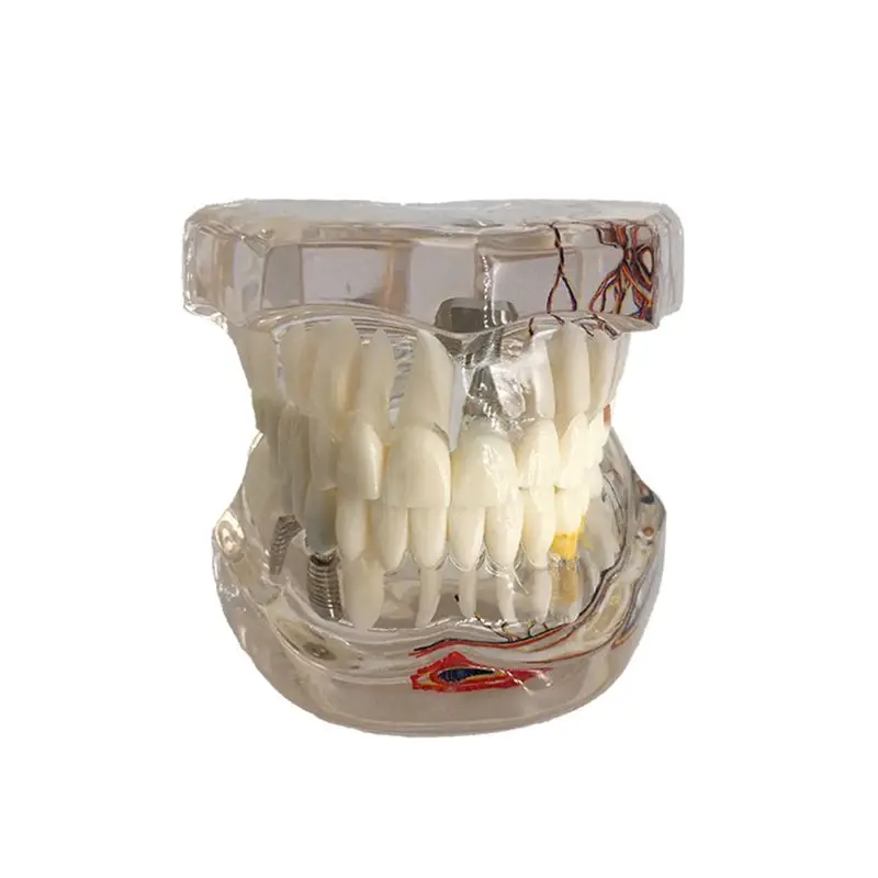 Dental Disease Implant Teeth Model with Restoration Bridge Tooth Dentist for Medical Science Disease Teaching Study
Dental Disease Implant Teeth Model with Restoration Bridge Tooth Dentist for Medical Science Disease Teaching Study