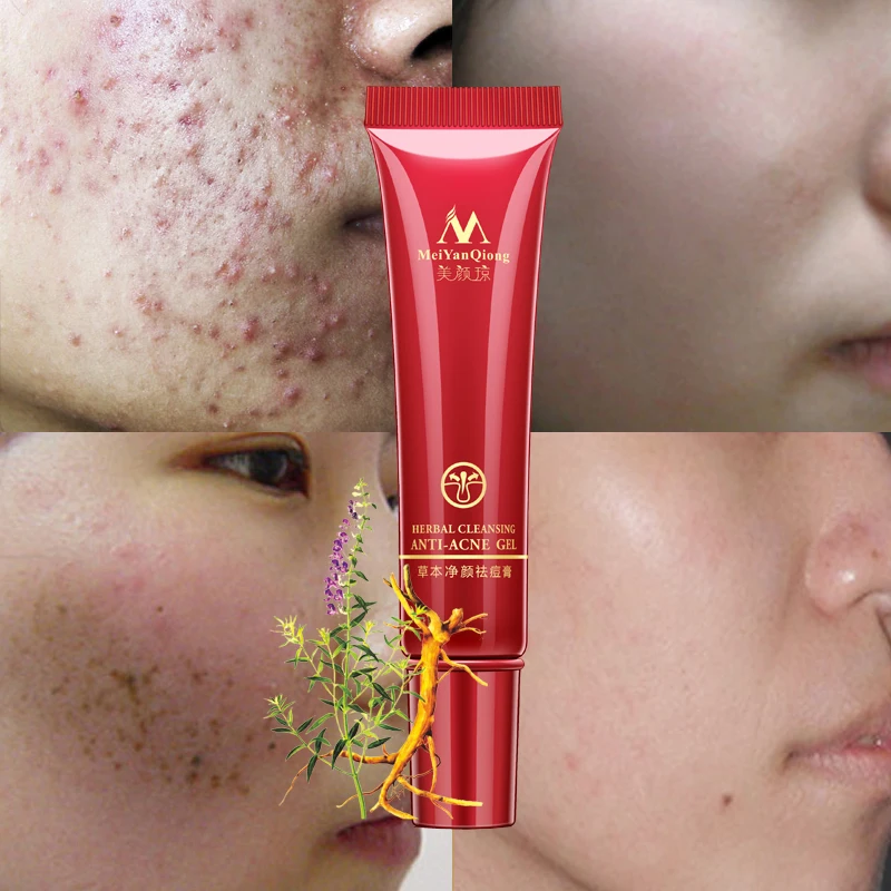 Effective Acne Removal Face Cream Treatment Acne Scar Spots Moisturizer Gel Oil Control Shrink Pores Whitening Korean Cosmetics
Effective Acne Removal Face Cream Treatment Acne Scar Spots Moisturizer Gel Oil Control Shrink Pores Whitening Korean Cosmetics