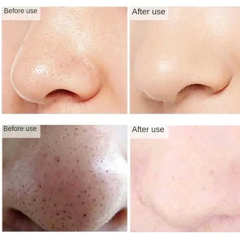 5-10-15-20pc Blackhead Acne Shrinking Pores Sucking Blackhead Mask Nasal Patch To Remove Oil and Moisturizing Skin Pore Cleanser
5-10-15-20pc Blackhead Acne Shrinking Pores Sucking Blackhead Mask Nasal Patch To Remove Oil and Moisturizing Skin Pore Cleanser