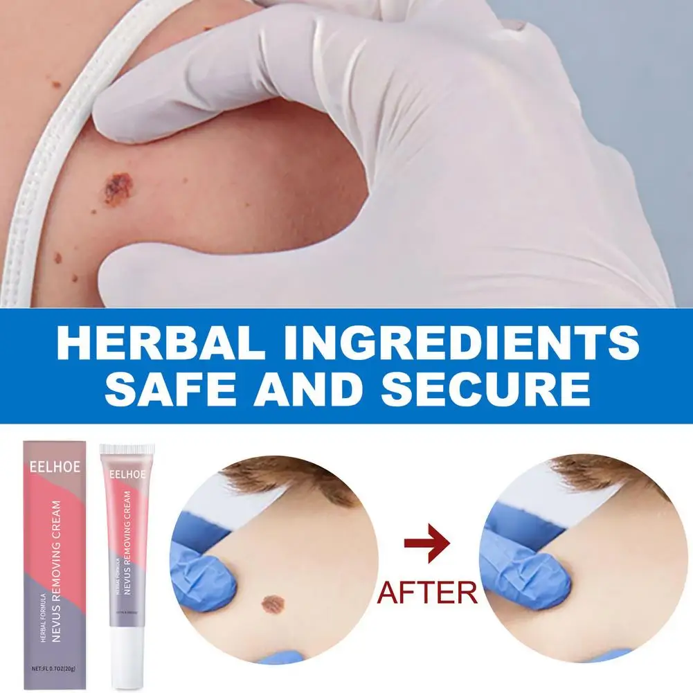 20g Skin Tags Warts Remover Cream Face Body Tag Remover Herbal Ointment Foot Corn Antibacterial Plaster Skin Beauty
20g Skin Tags Warts Remover Cream Face Body Tag Remover Herbal Ointment Foot Corn Antibacterial Plaster Skin Beauty