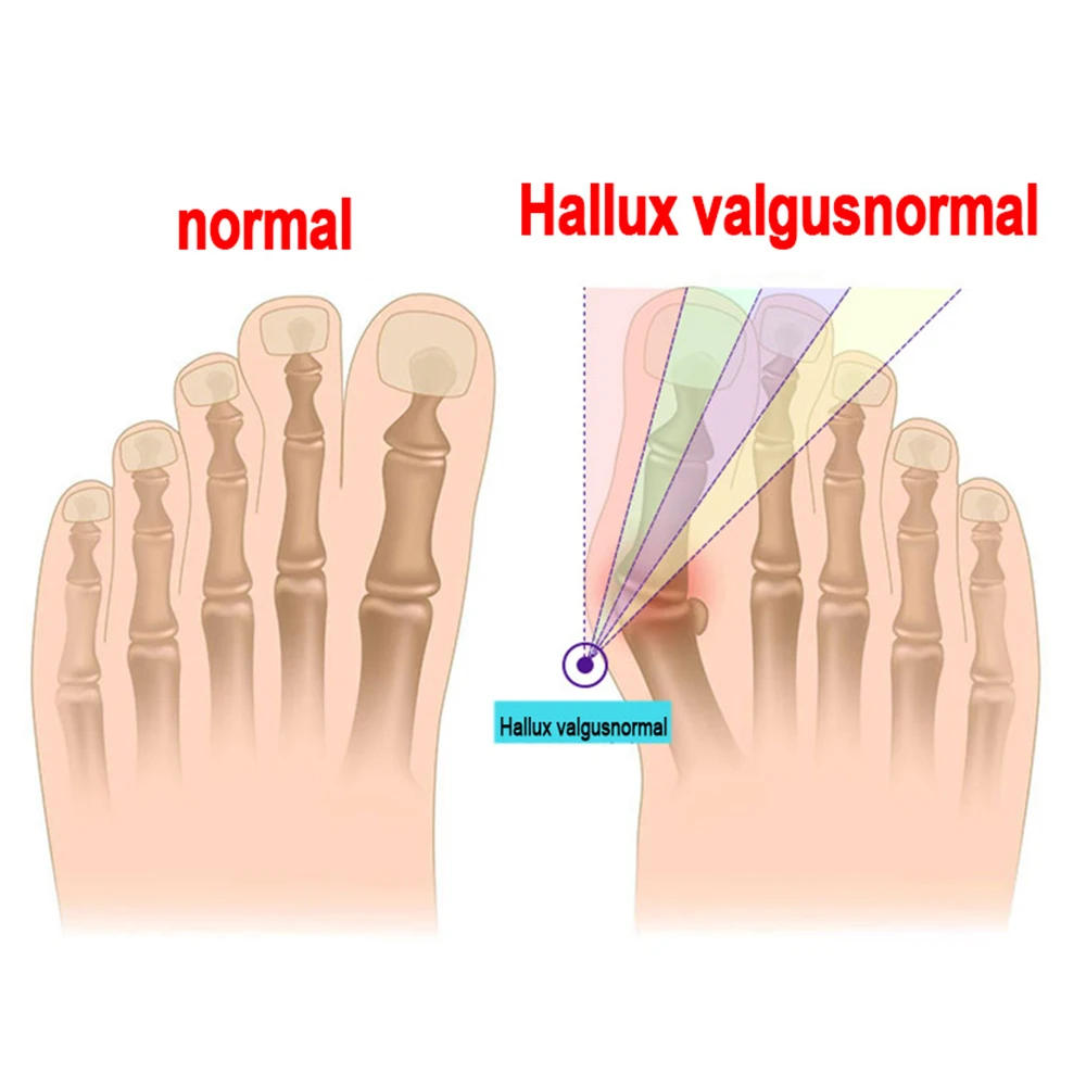 Silicone Bunion Corrector Toe Separators Foot Corrector Straightener For Toes Haluksy Calluses Pad Hallux Valgus Corrector
Silicone Bunion Corrector Toe Separators Foot Corrector Straightener For Toes Haluksy Calluses Pad Hallux Valgus Corrector