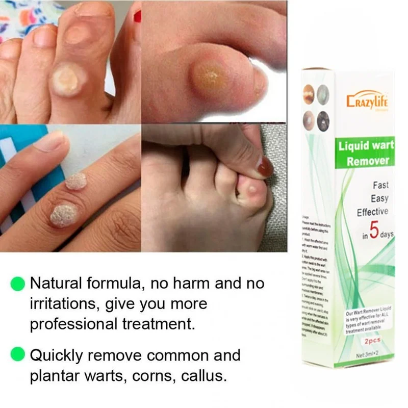 

Effective Wart Remover 3ml Skin Marker Anti Spot Warts To Remove Corns Medicinal Wart Remover Foot Skin Care Foot Peel