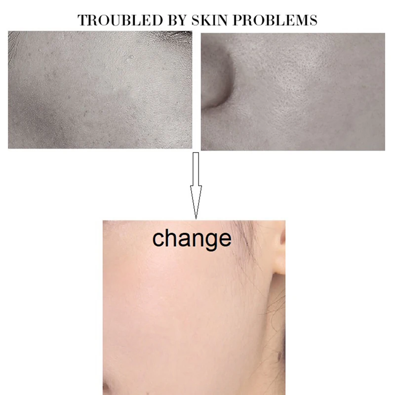 Whitening Moisturizer Skin Care Acne Treatment Face Cream Control Shrink Cream Pores Stretch Marks Pimple Removal Cream
Whitening Moisturizer Skin Care Acne Treatment Face Cream Control Shrink Cream Pores Stretch Marks Pimple Removal Cream