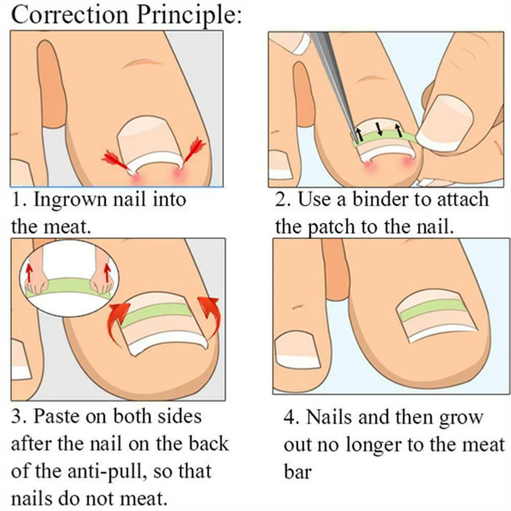 

12/24/36pcs Ingrown Toenail Elastic Patch Straightening Clip Brace with Glue Correction Paronychia Curved Feet Care Tool