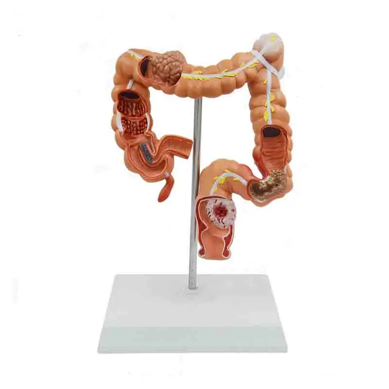 Human colon disease model anorectal Department of Gastroenterology large intestine model 
Human colon disease model anorectal Department of Gastroenterology large intestine model