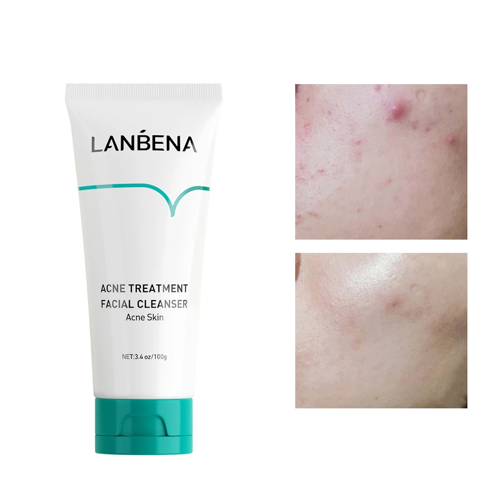 Acne Treatment Facial Cleanser Oil-control Remove Black Head Anti Acne Deep Cleansing Foam Shrink Pores Oil Free Wash Cream 100g
Acne Treatment Facial Cleanser Oil-control Remove Black Head Anti Acne Deep Cleansing Foam Shrink Pores Oil Free Wash Cream 100g