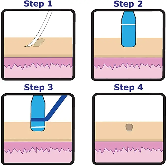 Micro Skin label Remover Skin Mole Wart Remover Band Home Use Cleansing Swabs Non Toxic Removal Acne Pimple Blemish Treatments
Micro Skin label Remover Skin Mole Wart Remover Band Home Use Cleansing Swabs Non Toxic Removal Acne Pimple Blemish Treatments