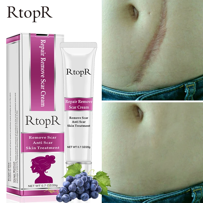 RtopR Acne Scar Stretch Marks Remover Cream Skin Repair Face Cream Acne Spots Acne Treatment Blackhead Whitening Cream Skin Care
RtopR Acne Scar Stretch Marks Remover Cream Skin Repair Face Cream Acne Spots Acne Treatment Blackhead Whitening Cream Skin Care