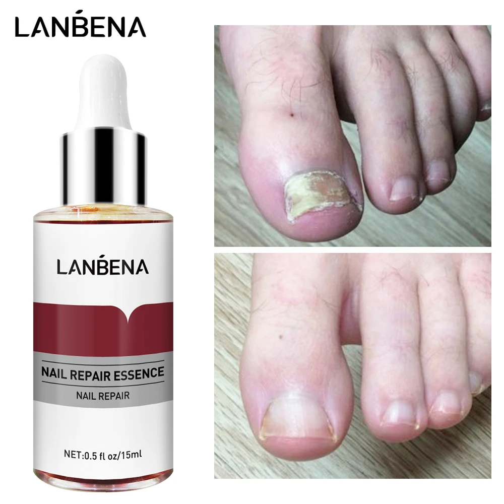 

Сыворотка LANBENA для восстановления ногтей, антигрибковое средство для ногтей, удаление онихомикоза, питание, осветление рук, ног, уход за ног...