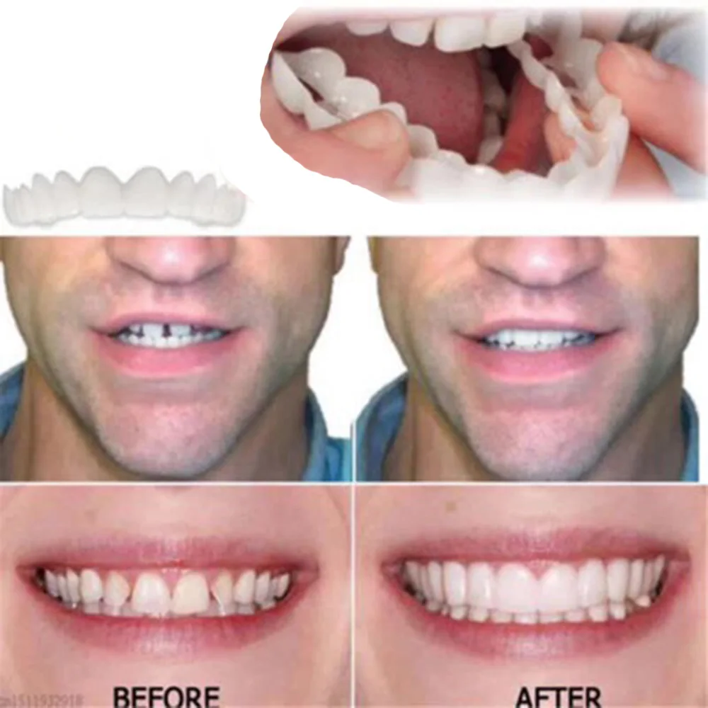Upper Lower Veneers False Teeth Plastic Snap-on Denture Bright White Shade Fake Braces Smil E Veneers Snap-on Cement
Upper Lower Veneers False Teeth Plastic Snap-on Denture Bright White Shade Fake Braces Smil E Veneers Snap-on Cement