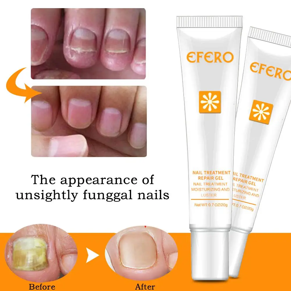 Лечение ногтей от грибков, гель для удаления грибка, восстанавливающий эссенция для ногтей, уход за ногами, эссенция для борьбы с инфекцией ...
Лечение ногтей от грибков, гель для удаления грибка, восстанавливающий эссенция для ногтей, уход за ногами, эссенция для борьбы с инфекцией ...