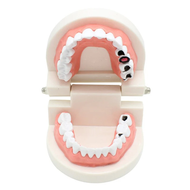 Dentist Caries Model for Teaching Decay Tooth Model Teeth Care Dental Study Model Dentistry Lab Material Tool
Dentist Caries Model for Teaching Decay Tooth Model Teeth Care Dental Study Model Dentistry Lab Material Tool