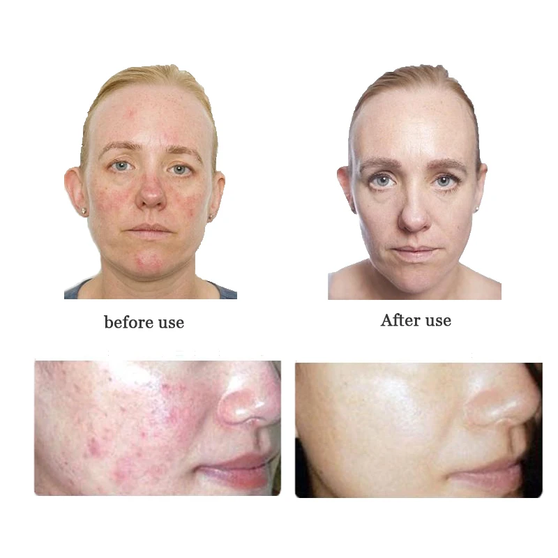 Yoni steam detox steam female skin cleansing kit Yonisteam 100% Chinese herbal medicine facial cleansing kit for women Chinese
Yoni steam detox steam female skin cleansing kit Yonisteam 100% Chinese herbal medicine facial cleansing kit for women Chinese
