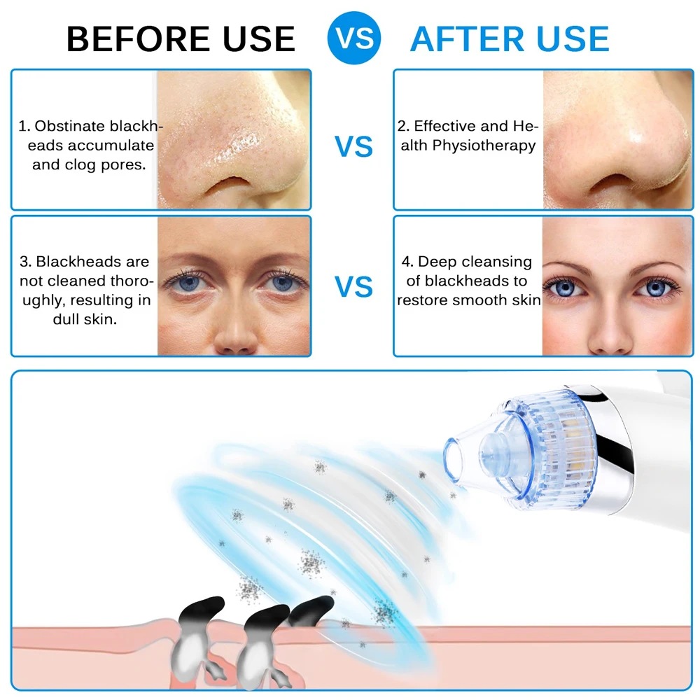 Fast Effective Blackhead Removal Equipment Acne Cleaner Black Head Cleaner Skin Care Blackhead Beauty ABS White
Fast Effective Blackhead Removal Equipment Acne Cleaner Black Head Cleaner Skin Care Blackhead Beauty ABS White