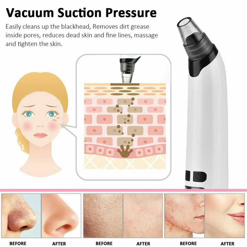 4-head Dser Import Blackhead Remover T Zone Pore Acne Pimple Removal Face Deep Nose Cleaner Vacuum Suction Facial Clean
4-head Dser Import Blackhead Remover T Zone Pore Acne Pimple Removal Face Deep Nose Cleaner Vacuum Suction Facial Clean
