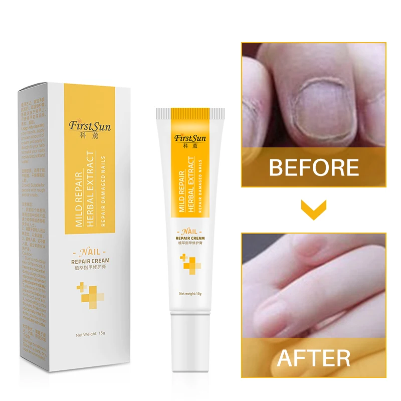 Nail Fungus Removal Cream Onychomycosis Fungal Nail Treatment Serum Paronychia Anti Infection Feet Toe Fungal Nail Care Gel
Nail Fungus Removal Cream Onychomycosis Fungal Nail Treatment Serum Paronychia Anti Infection Feet Toe Fungal Nail Care Gel