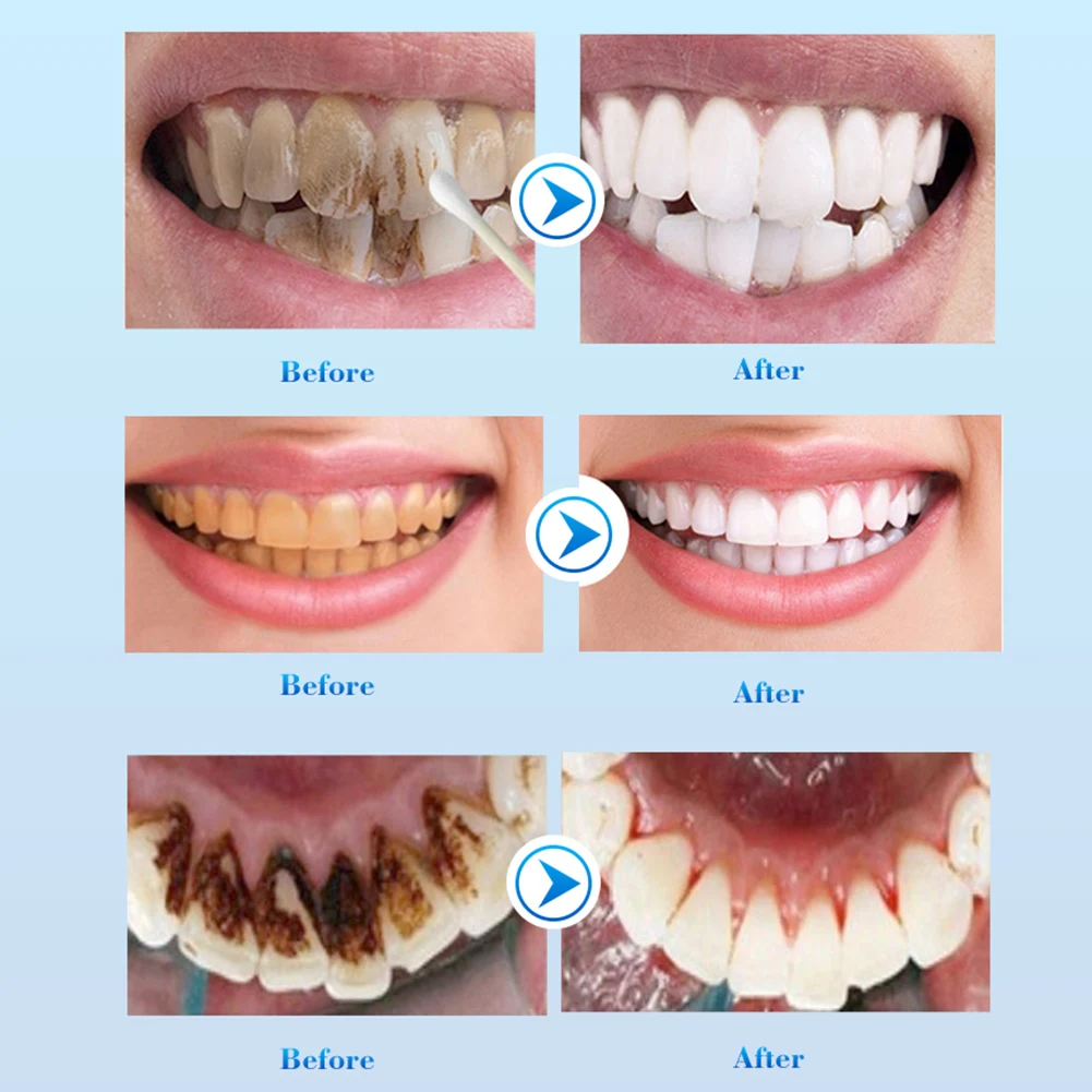 Teeth Whitening Essence Remove Stains Caused by Coffee Tea Freshen Breath Teeth Brighting Serum Oral Health Care
Teeth Whitening Essence Remove Stains Caused by Coffee Tea Freshen Breath Teeth Brighting Serum Oral Health Care