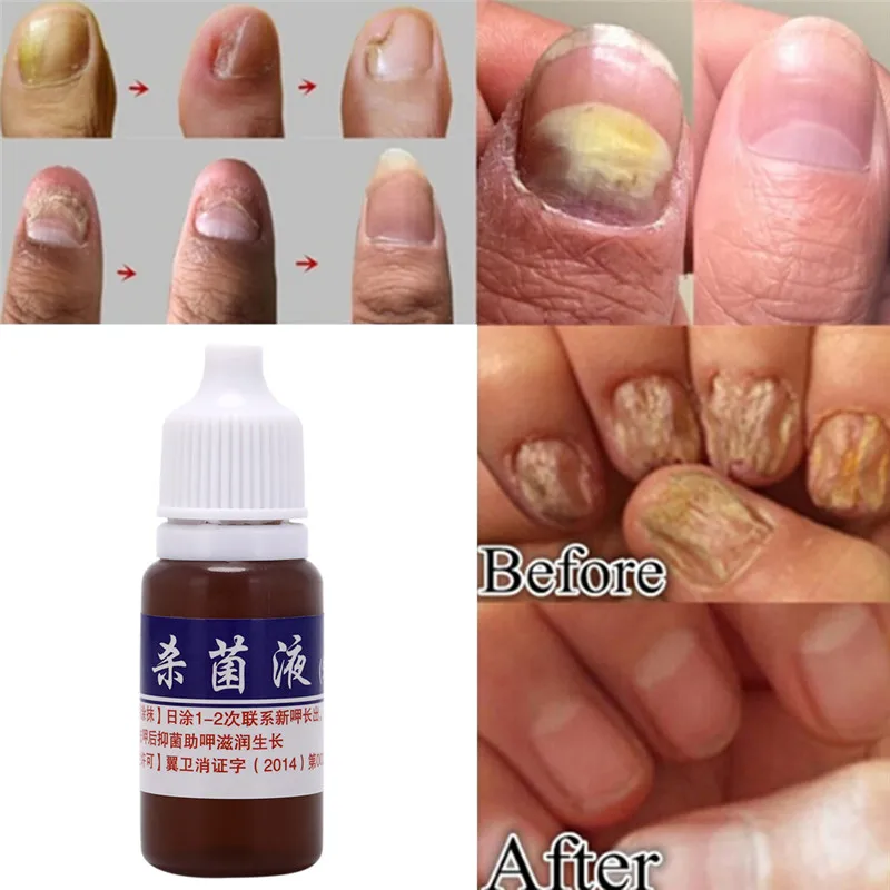 Nail Repair Fungal Nail Treatment Remove Toe Onychomycosis Remover Serum Nail Fungus Repair Treatment For Health Skin Care
Nail Repair Fungal Nail Treatment Remove Toe Onychomycosis Remover Serum Nail Fungus Repair Treatment For Health Skin Care