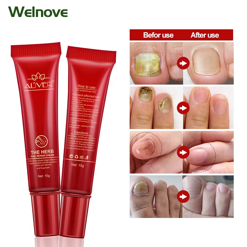 1Pcs Fingers Feet Nail Anti Fungi Treatment Ointment Onychomycosis Paronychia Herbal Repair Cream Nail Fungus Infection Plaster
1Pcs Fingers Feet Nail Anti Fungi Treatment Ointment Onychomycosis Paronychia Herbal Repair Cream Nail Fungus Infection Plaster