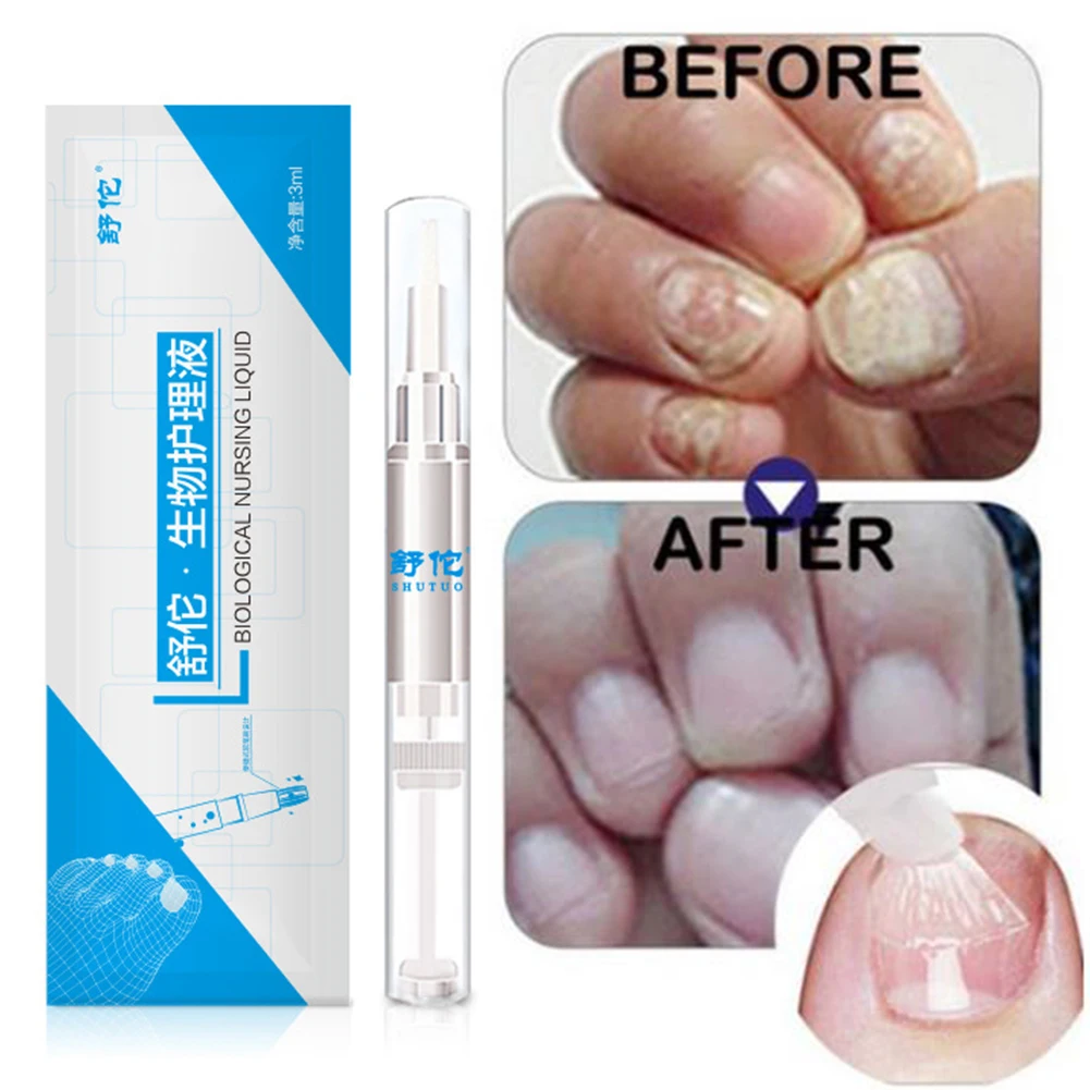Hot sell 3ml Anti Fungal Treatment Nail Pen Onychomycosis Paronychia Infection Chinese Herbal Finger Nails Health Care Dropship
Hot sell 3ml Anti Fungal Treatment Nail Pen Onychomycosis Paronychia Infection Chinese Herbal Finger Nails Health Care Dropship