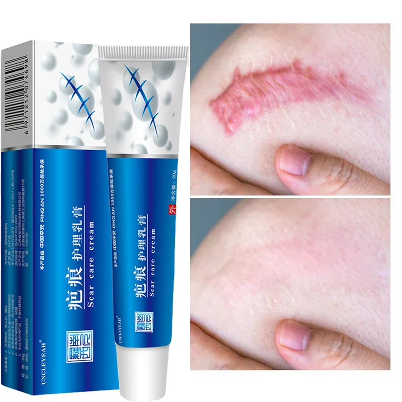 Acne Scar Removal Cream Pimples Stretch Marks Face Gel Remove Acne Smoothing Whitening Moisturizing Body Skin Care Aichun
Acne Scar Removal Cream Pimples Stretch Marks Face Gel Remove Acne Smoothing Whitening Moisturizing Body Skin Care Aichun