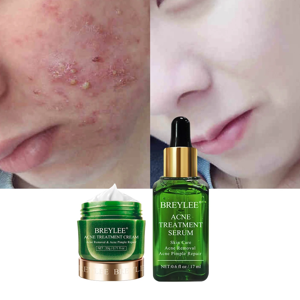 BREYLEE Acne Treatment Kit Acne Solution Serum Spots Pimple Removal Essence Anti Acne Scar Whitening Face Skin Care 2pcs
BREYLEE Acne Treatment Kit Acne Solution Serum Spots Pimple Removal Essence Anti Acne Scar Whitening Face Skin Care 2pcs