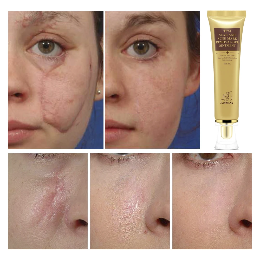 LANBENA Acne Scar Stretch Marks Remover Cream Skin Repair Cream Blackhead Whitening Stretch Marks Ginseng Extract Face Care Gel
LANBENA Acne Scar Stretch Marks Remover Cream Skin Repair Cream Blackhead Whitening Stretch Marks Ginseng Extract Face Care Gel