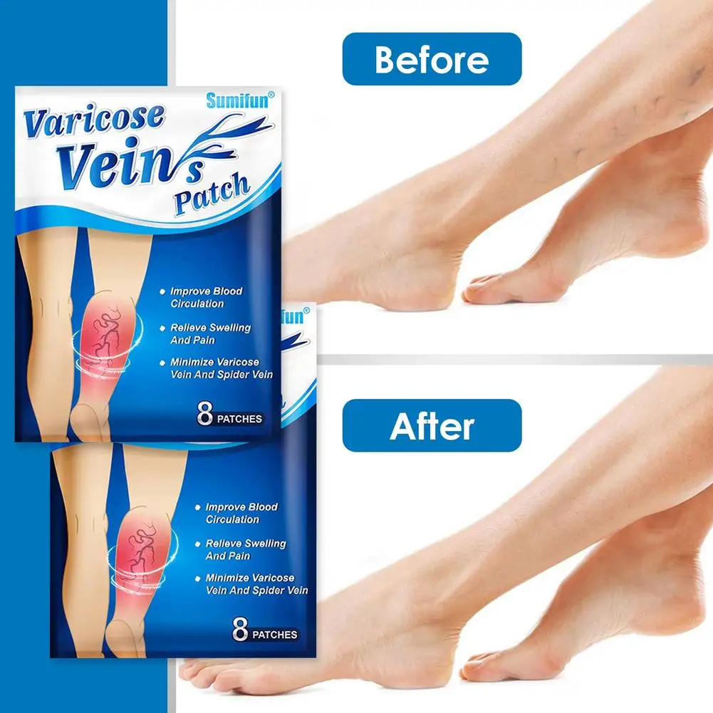 Sumifun 8pcs/bag Chinese Varicose Veins Plaster Vasculitis Phlebitis Spider Leg Medical Patch Angiitis Removal Patch
Sumifun 8pcs/bag Chinese Varicose Veins Plaster Vasculitis Phlebitis Spider Leg Medical Patch Angiitis Removal Patch