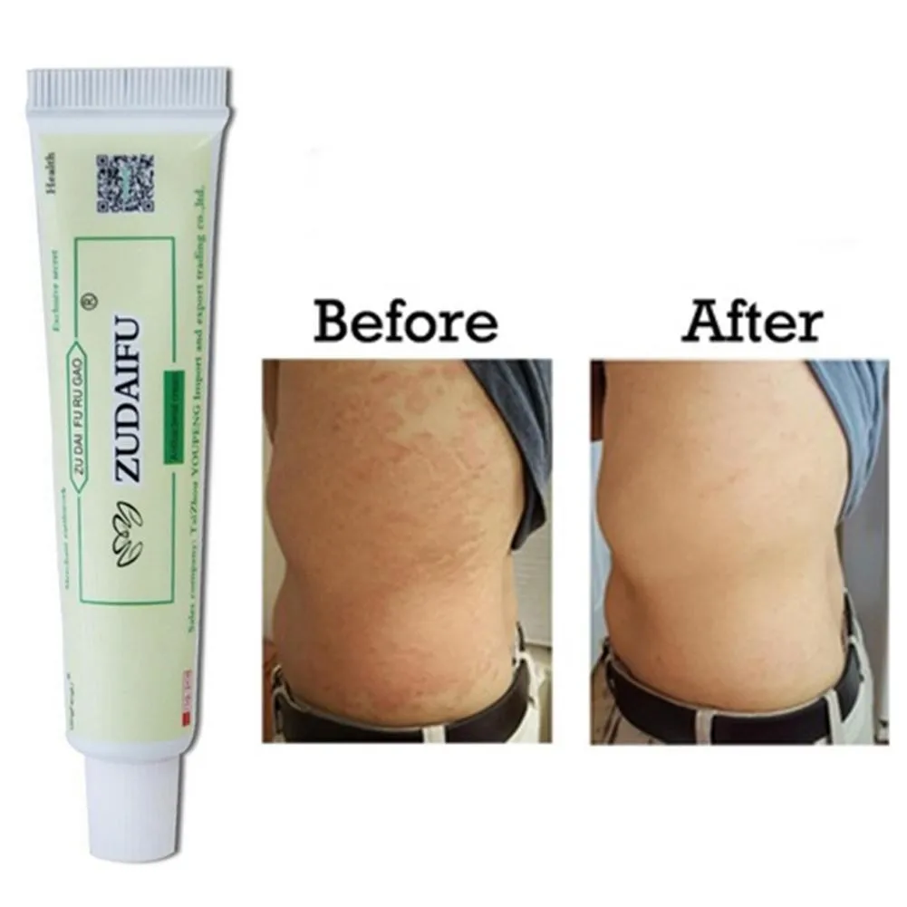 5/15g Cream Psoriasis Treatment Ointment Dermatitis Eczematoid Eczema Ointment Skin Repair Plaster Psoriasis Care Creams
5/15g Cream Psoriasis Treatment Ointment Dermatitis Eczematoid Eczema Ointment Skin Repair Plaster Psoriasis Care Creams