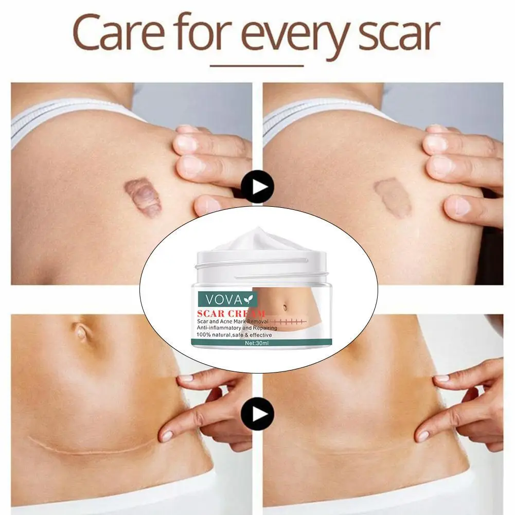 30g Acne Scar Removal Cream Pimples Stretch Marks Face Care Remove Gel Acne Moisturizing Skin Smoothing Body Whitening H5A3
30g Acne Scar Removal Cream Pimples Stretch Marks Face Care Remove Gel Acne Moisturizing Skin Smoothing Body Whitening H5A3