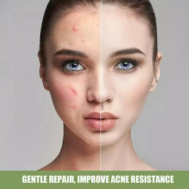 Salicylic Acid Ultra Cleansing Mask Ice Cream Mask Fades Acne Marks Blackheads Moisturizing Cleansing Portable ZGOOD
Salicylic Acid Ultra Cleansing Mask Ice Cream Mask Fades Acne Marks Blackheads Moisturizing Cleansing Portable ZGOOD