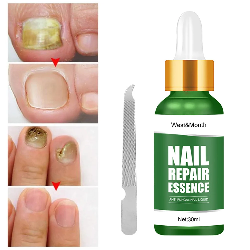 Nail Fungus Treatment Feet Care Essence Nails Foot Repair Toe Nail Fungal Removal Gel Anti Infection Paronychia Onychomycosis
Nail Fungus Treatment Feet Care Essence Nails Foot Repair Toe Nail Fungal Removal Gel Anti Infection Paronychia Onychomycosis