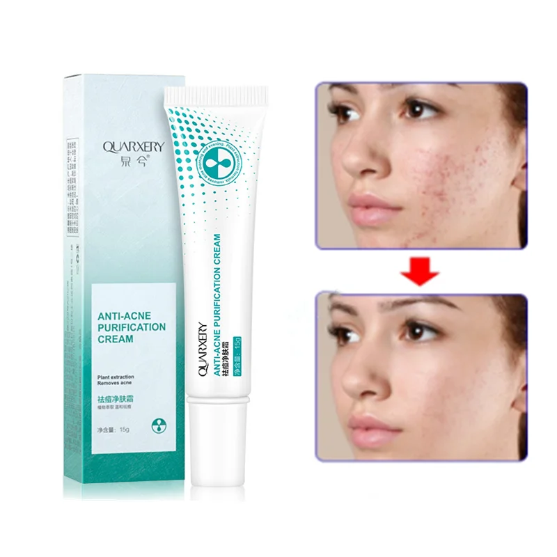 Эффективный крем для акне, 15 г, никотинамид, контроль жирности, сужение пор, выцветание, следы акне, отбеливание, увлажнение, уход за кожей 
Эффективный крем для акне, 15 г, никотинамид, контроль жирности, сужение пор, выцветание, следы акне, отбеливание, увлажнение, уход за кожей