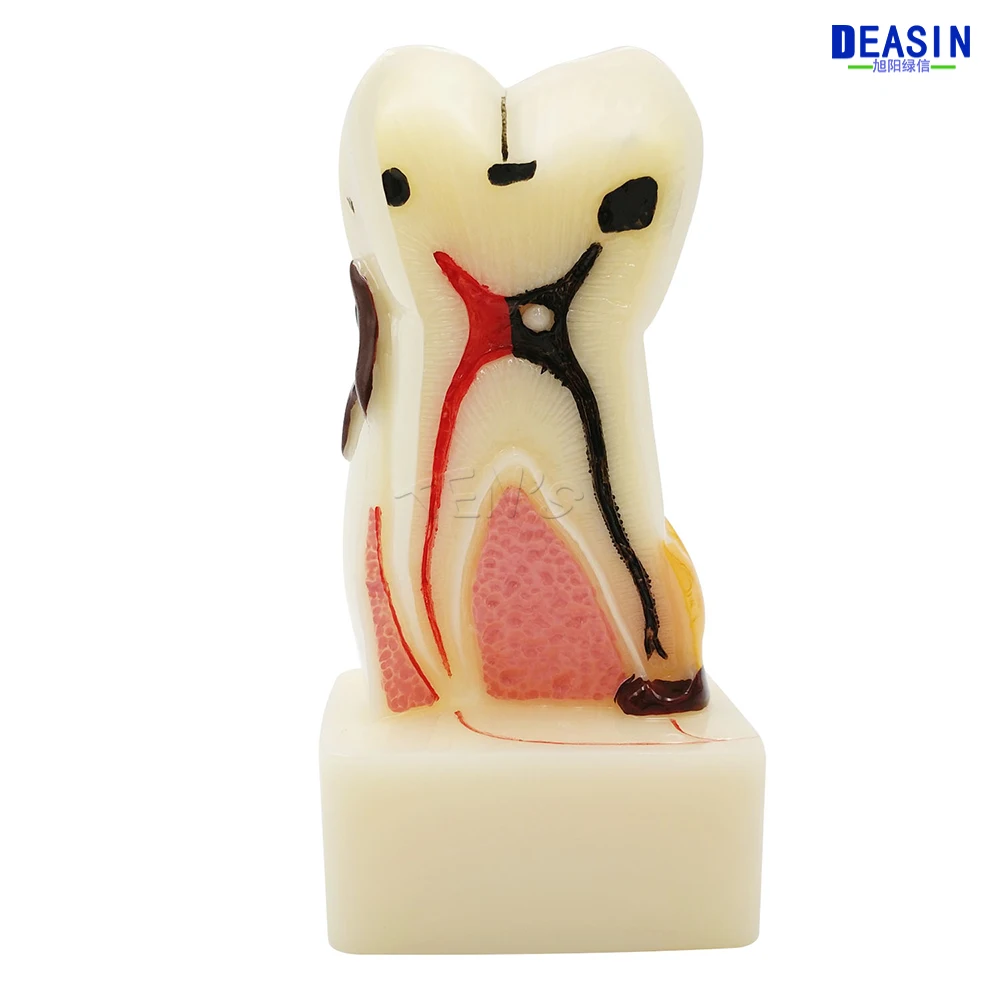 2016 New Four times size dental pathology teeth model, dental caries, calculus, pulp stones, Occlusal tooth wear
2016 New Four times size dental pathology teeth model, dental caries, calculus, pulp stones, Occlusal tooth wear